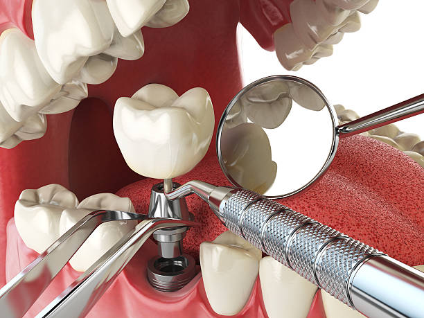Best Emergency Dentist for Lost Fillings or Crowns in Attica, IN